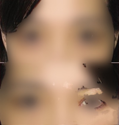 眼袋毁了我的青春 内切法去眼袋让我重生