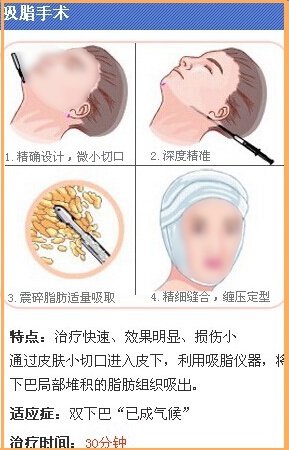 吸脂去双下巴
