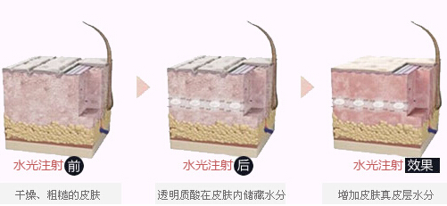水光注射过程