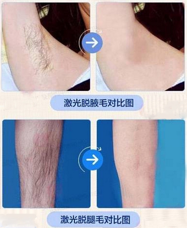 激光脱毛效果图