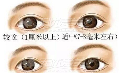 双眼皮宽变窄该怎么修复何时修复