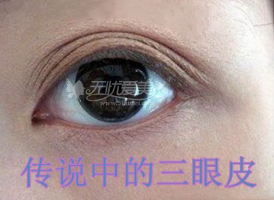 双眼皮宽变窄该怎么修复何时修复