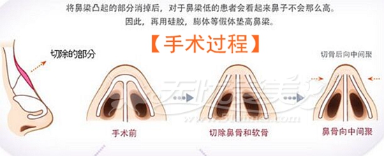 告别驼峰鼻我有一套