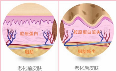 如果超声刀是去掉皱纹留下疤痕 你还敢用吗?