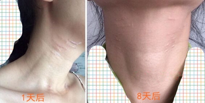 如果超声刀是去掉皱纹留下疤痕 你还敢用吗?