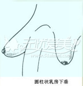 乳房下垂形态