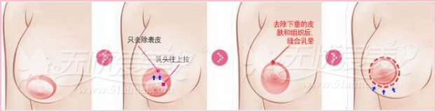 乳房下垂矫正