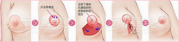 乳房下垂矫正
