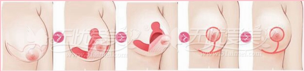乳房下垂矫正