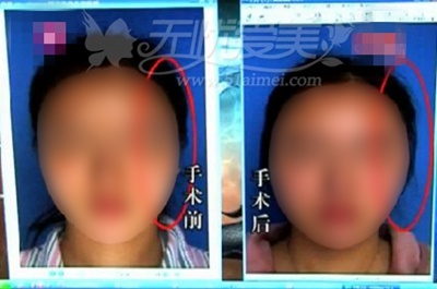 "瓜子脸"整成"大饼脸"?都是假玻尿酸闹的!