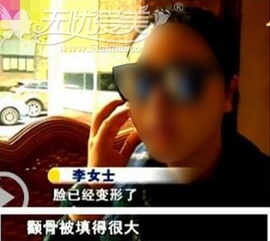 假玻尿酸毁容