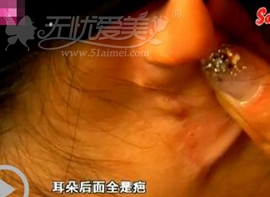 假玻尿酸毁容