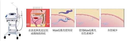 MaxG激光
