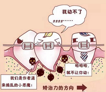 牙齿矫正会松动