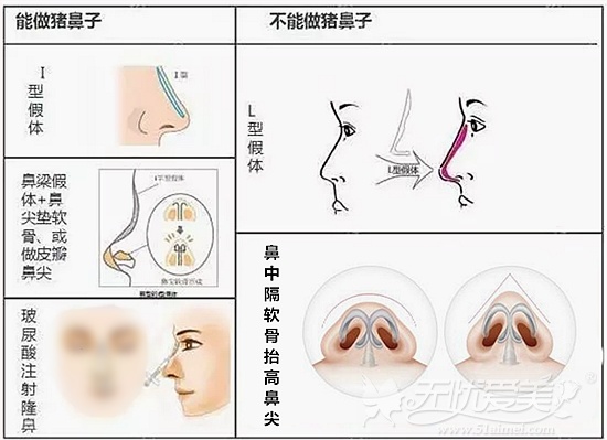 隆鼻手术后到底能不能做猪鼻子?