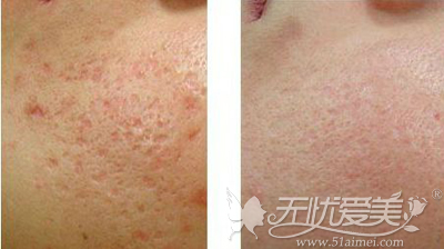 点阵激光去痘印前后对比案例