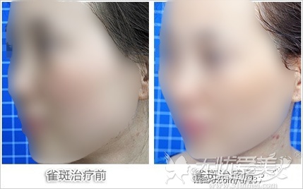 【真人真问】专家富秋涛讲解关于激光祛斑的二三事