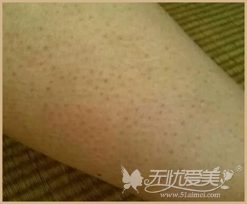 黑点型鸡皮肤