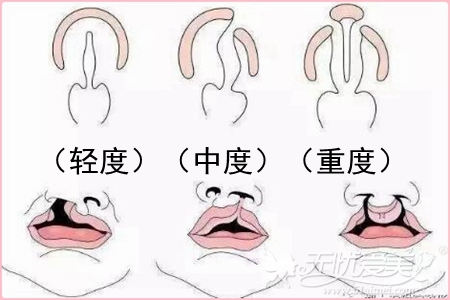 唇腭裂修复最佳时机?
