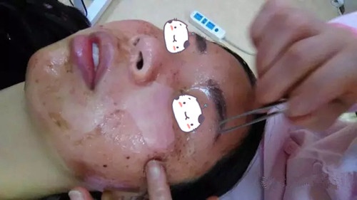 梁小姐在南昌广济五天基因祛雀斑第5天 梁小姐在南昌广济五天基因祛雀斑第5天