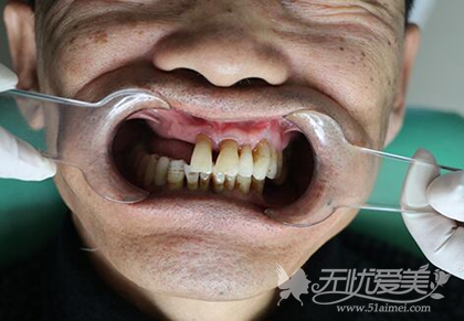 北京维尔口腔手术前 北京维尔口腔手术前