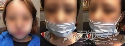 颧骨缩小术并不是单纯的将颧骨内推就行了,而是要结合正面和侧面的