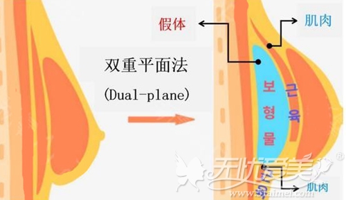 分层次植入假体术后手感更自然
