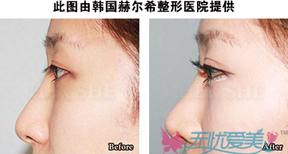 隆鼻前后对比图一
