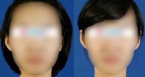 隆鼻前后对比图二