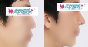 隆鼻效果对比图二