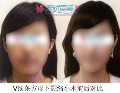 韩国FACE-LINE整形医院做双颚手术多少钱