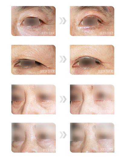 韩国赫尔希整形外科医院矫正眼眸的对比图片