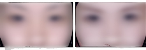 韩国艺德雅整形外科双眼皮前后对比图_韩国艺德雅整形外科医院