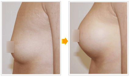 韩国赫尔希整形假体隆胸前后对比图