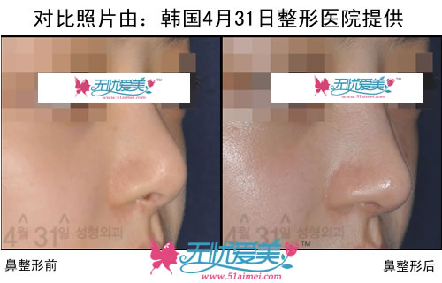 韩国4月31日整形医院鼻部整形前后对比照片