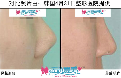 韩国4月31日整形医院鼻部整形前后对比照片