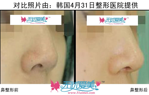 韩国4月31日整形医院鼻部整形前后对比照片