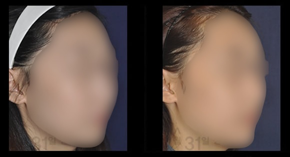 韩国4月31日做鼻子的手术案例对比图