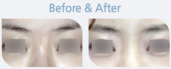 韩国BK整形医院注射美白针案例