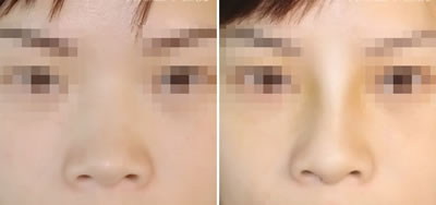 假体隆鼻手术前后对比效果图