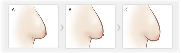 乳房下垂不同程度示意图