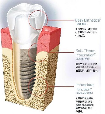 有哪些方法可以延长种植牙的寿命