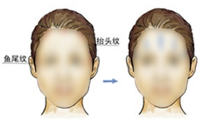 电波拉皮除皱术效果究竟好吗