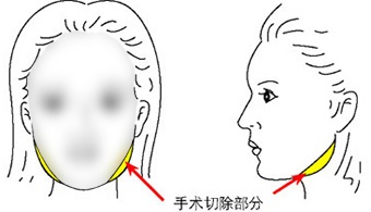 我想做下颌角手术，风险大吗