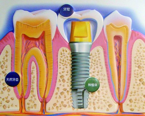 种植牙示意图