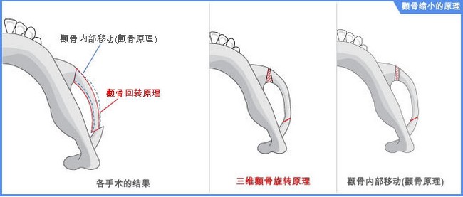 颧骨降低术会导致皮肤松弛吗