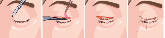 做完双眼皮整形手术后眼部皮肤会变松弛吗