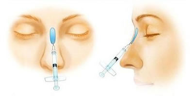 注射隆鼻过程示意图