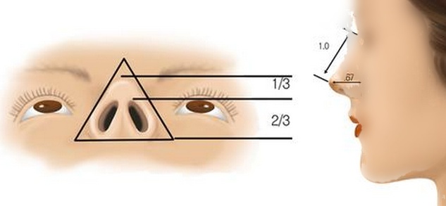 鼻尖整形示意图