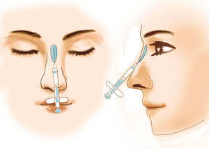 注射隆鼻的材料多久能被人体吸收